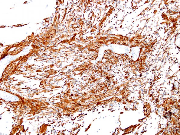 2G1 Ganglioglioma (Case 2) GFAP 2