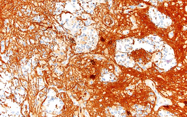 2G2 Ganglioglioma (Case 2) GFAP 20X