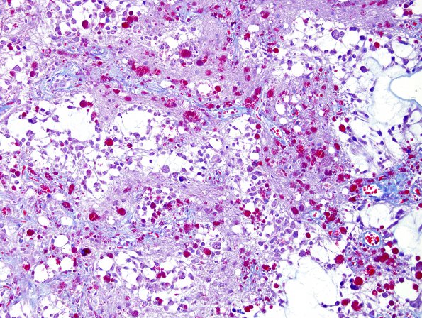 2H1 Ganglioglioma (Case 2) Trichrome 2