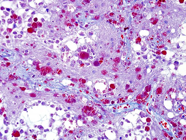 2H2 Ganglioglioma (Case 2) Trichrome 1