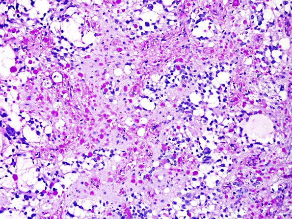 2H3  Ganglioglioma (Case 2) PAS with