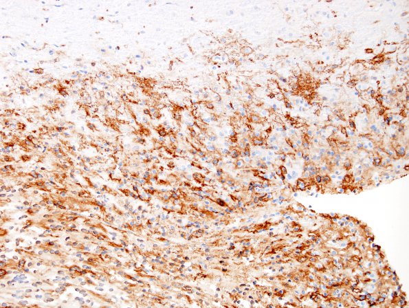 2I Ganglioglioma Case 2) CD34 1