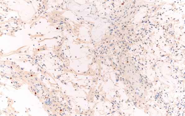 2J Ganglioglioma (Case 2) Ki67 20X