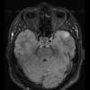 3A1 Ganglioglioma (Case 3) FLAIR 1 - Copy