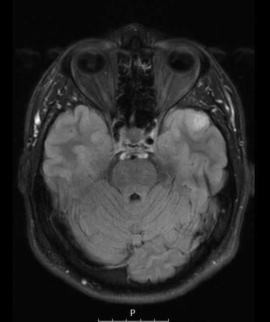 3A1 Ganglioglioma (Case 3) FLAIR 1 - Copy