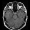 3A2 Ganglioglioma (Case 3) T1noC 1 - Copy