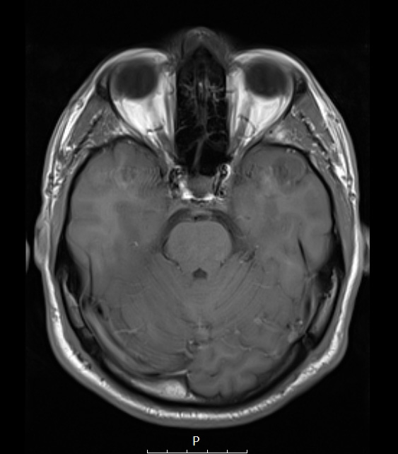 3A2 Ganglioglioma (Case 3) T1noC 1 - Copy