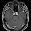 3A3 Ganglioglioma (Case 3) T1 Fat Sat W 1 - Copy