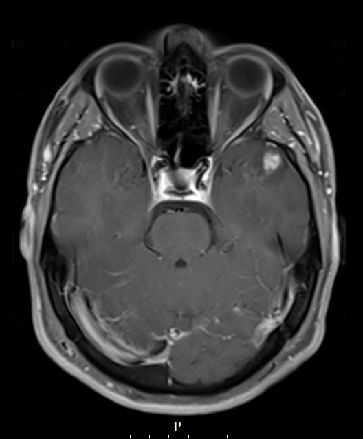 3A3 Ganglioglioma (Case 3) T1 Fat Sat W 1 - Copy