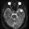 3A4 Ganglioglioma (Case 3) T2W 1 - Copy