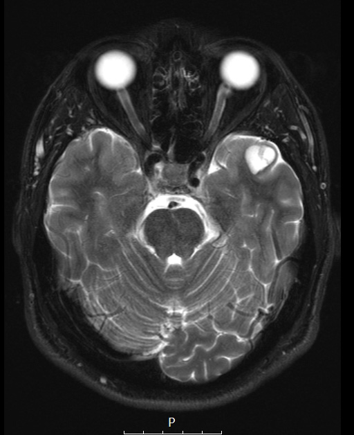 3A4 Ganglioglioma (Case 3) T2W 1 - Copy