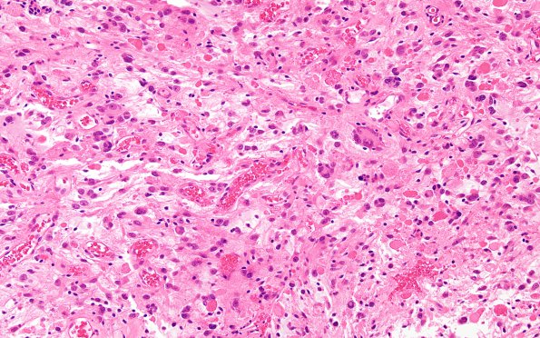 3B2 Ganglioglioma (Case 3) H&E 1