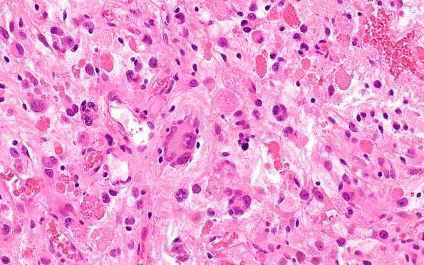 3B3 Ganglioglioma (Case 3) H&E 4