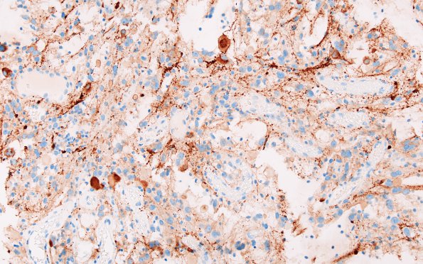 3C1 Ganglioglioma (Case 3) SYN 4