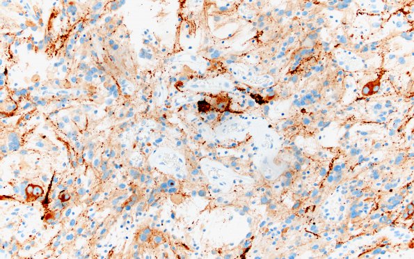 3C2 Ganglioglioma (Case 3) SYN 7