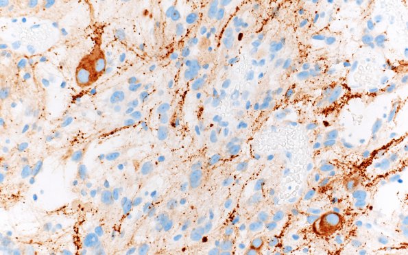 3C3 Ganglioglioma (Case 3) SYN 8