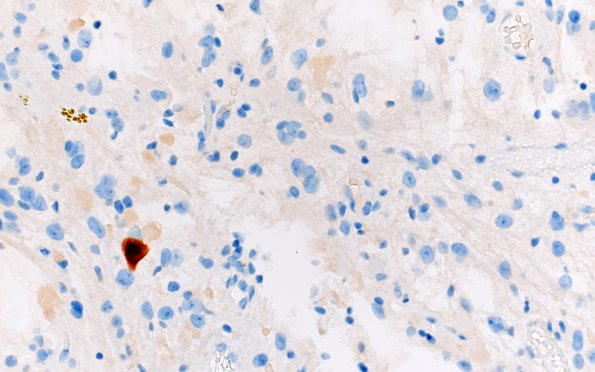 3D Ganglioglioma (Case 3) NeuN 40X