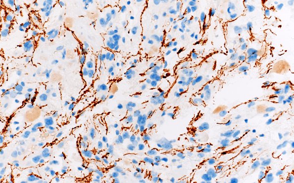 3E Ganglioglioma (Case 3) NF 40X