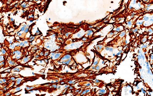 3F1 Ganglioglioma (Case 3) GFAP 1