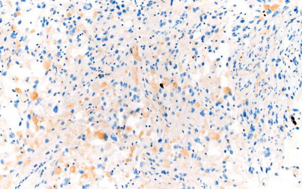 3I1 Ganglioglioma (Case 3) Ki67 20X (2)