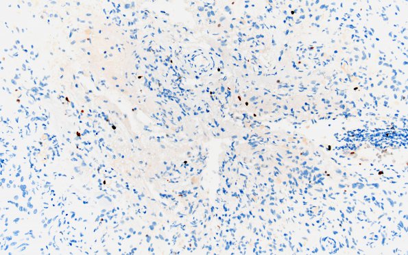 3I2 Ganglioglioma (Case 3) Ki67 20X 2