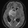 4A1 Ganglioglioma (Case 4) FLAIR - Copy