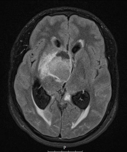 4A1 Ganglioglioma (Case 4) FLAIR - Copy