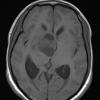 4A2 Ganglioglioma (Case 4) T1 noC - Copy