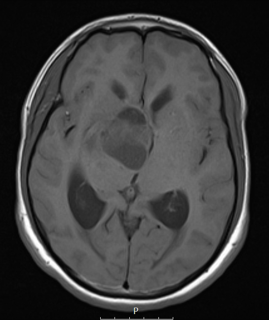 4A2 Ganglioglioma (Case 4) T1 noC - Copy