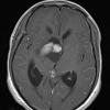 4A3 Ganglioglioma (Case 4) T1W - Copy