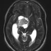 4A4 Ganglioglioma (Case 4) T2 noC - Copy