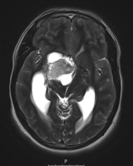 4A4 Ganglioglioma (Case 4) T2 noC - Copy