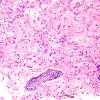 4B1 Ganglioglioma (Case 4) H&E 1