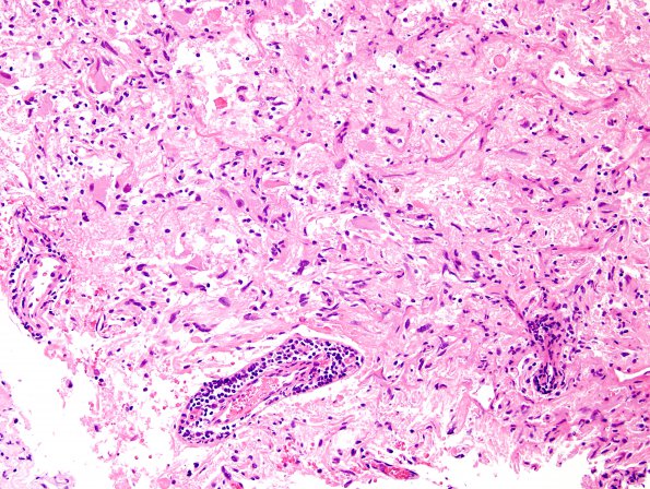 4B1 Ganglioglioma (Case 4) H&E 1