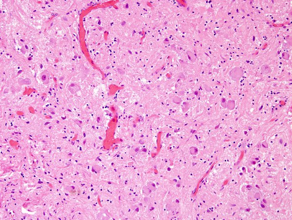 4B2 Ganglioglioma (Case 4) H&E 2