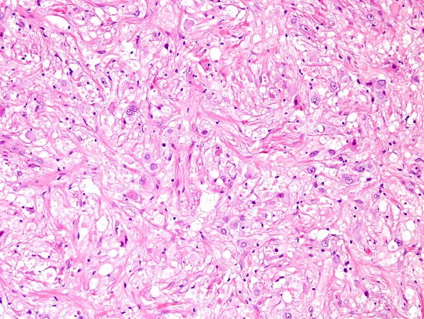 4B3 Ganglioglioma (Case 4) H&E 3