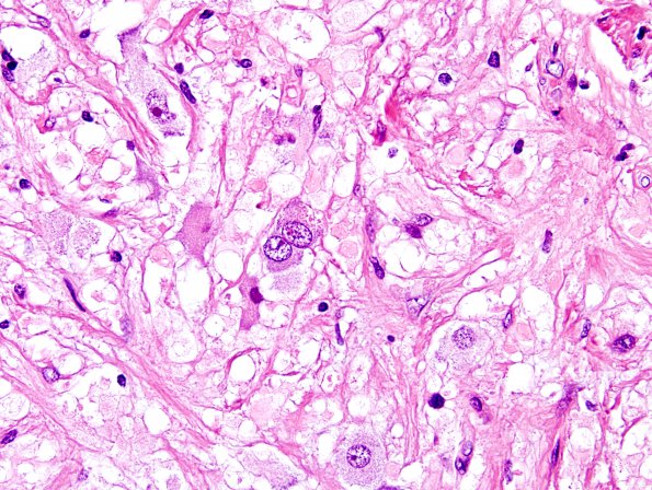 4B4 Ganglioglioma (Case 4 H&E 5