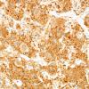 4C Ganglioglioma (Case 4) SYN 3