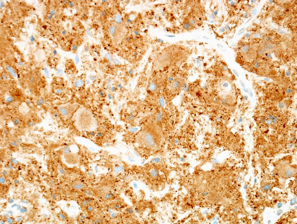 4C Ganglioglioma (Case 4) SYN 3