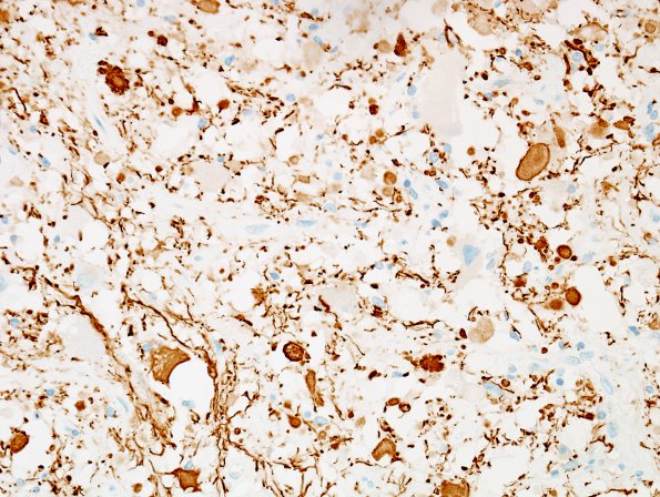 4D Ganglioglioma (Case 4) NF 4