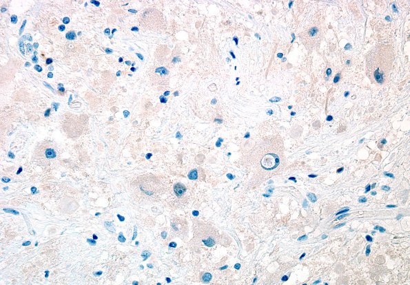 4F Ganglioglioma (Case 4) NeuN 1