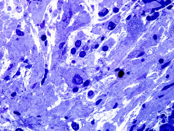 4H Ganglioglioma (Case 4) Plastic 4