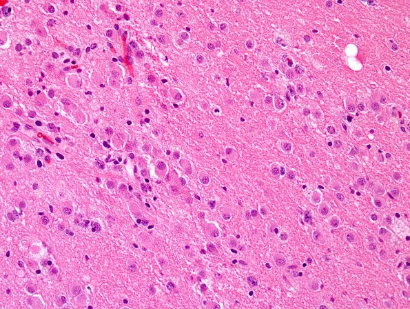 5A1 Ganglioglioma-gangliocytoma (Case 5) H&E 1.jpg