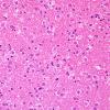 5A2 Ganglioglioma-gangliocytoma (Case 5) H&E 7.jpg