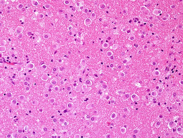 5A2 Ganglioglioma-gangliocytoma (Case 5) H&E 7.jpg