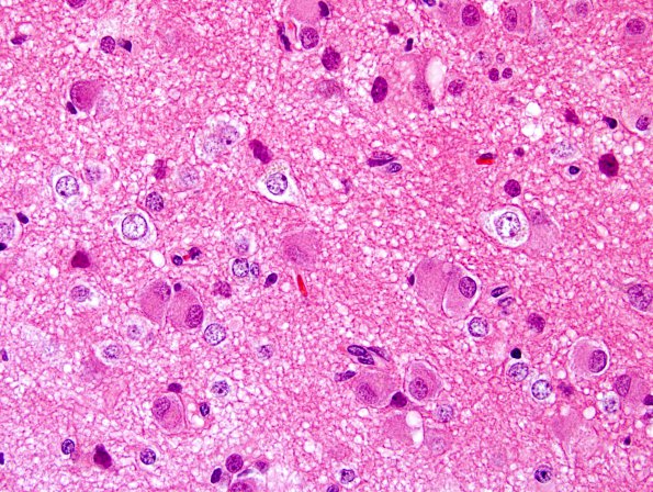 5A3 Ganglioglioma-gangliocytoma (Case 5) H&E 5.jpg