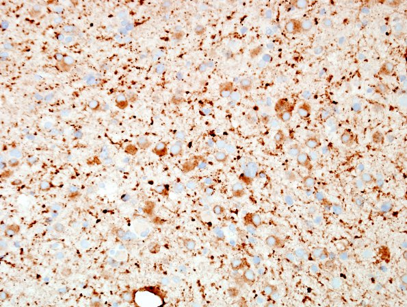 5B Ganglioglioma-gangliocytoma (Case 5) SYN 3.jpg