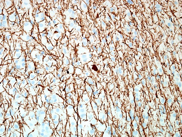 5C Ganglioglioma-gangliocytoma (Case 5) NF 6.jpg