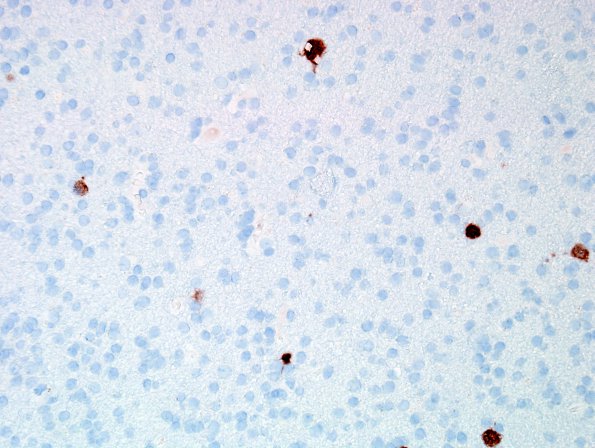 5D Ganglioglioma-gangliocytoma (Case 5) NeuN 4.jpg