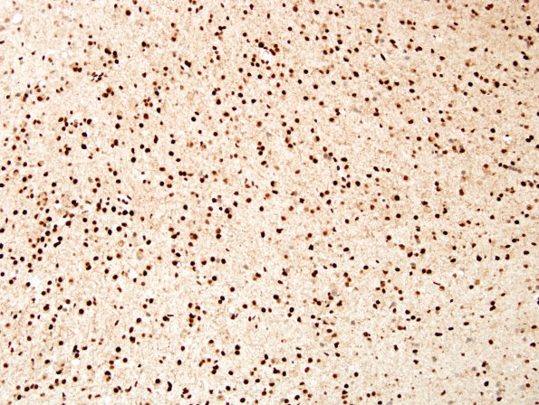 5F Ganglioglioma-gangliocytoma (Case 5) ATRX 3.jpg